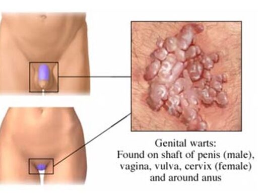 premature-ejaculation-treatment-in-noida