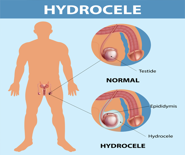 premature-ejaculation-treatment-in-noida