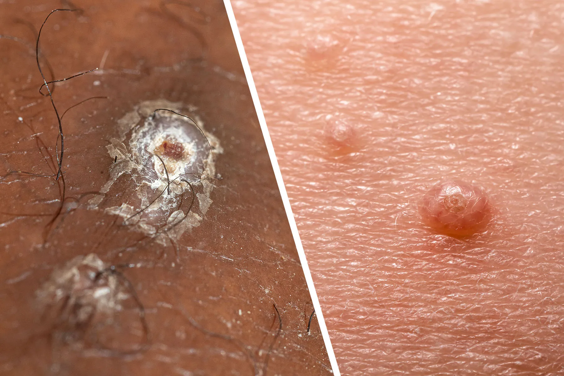 premature-ejaculation-treatment-in-noida