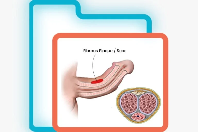 premature-ejaculation-treatment-in-noida